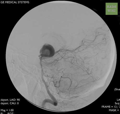 Cranial Angiography: Same case as in MSCT images. A large basilar artery aneurysm
