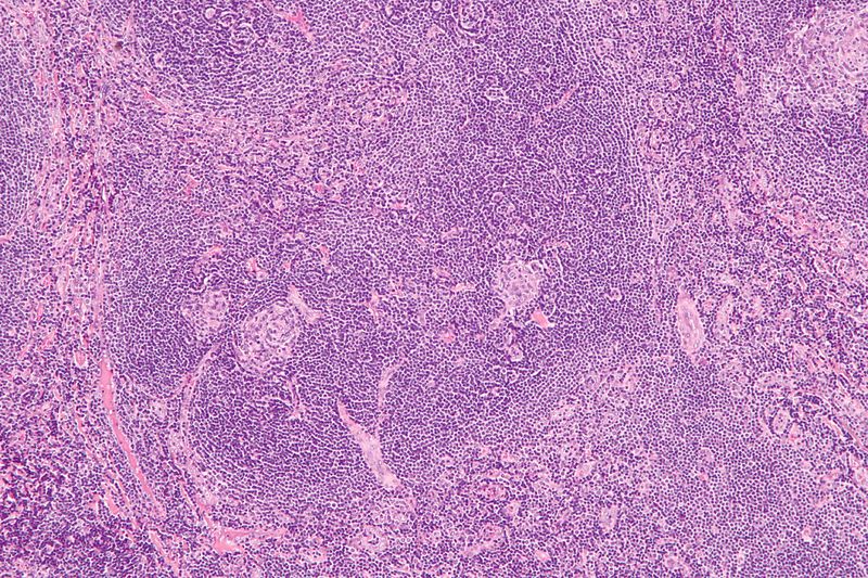 File:Castleman disease - Plasma cell variant.jpg
