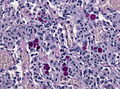 A smear showing secretory meningioma with PAS stain positive secretory granules