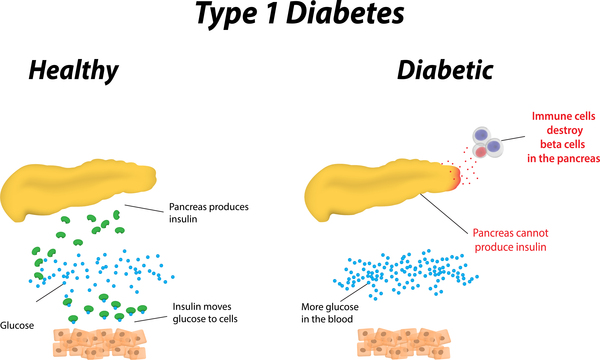 research type 1 diabetic