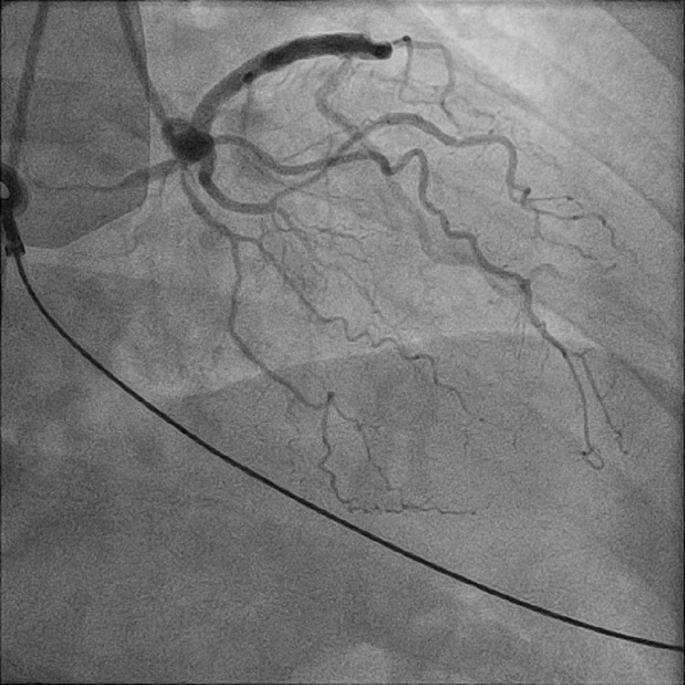 Figure 4. Right anterior oblique cineangiography of selective coronary injection of the right coronary artery (RCA). LCx (left circumflex coronary artery); LAD (left anterior descending coronary artery)
