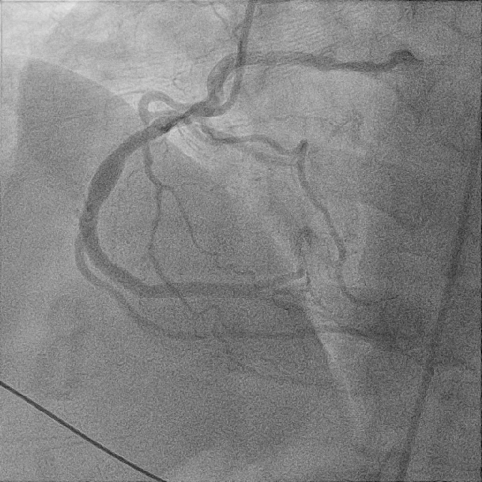 Figure 5. Left anterior oblique cineangiography of the right coronary artery (RCA) following coronary stenting of the mid-vessel occlusion. LCx (left circumflex coronary artery); LAD (left anterior descending coronary artery)