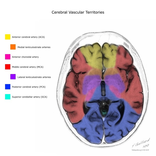 Cerebral vascular territories.jpeg