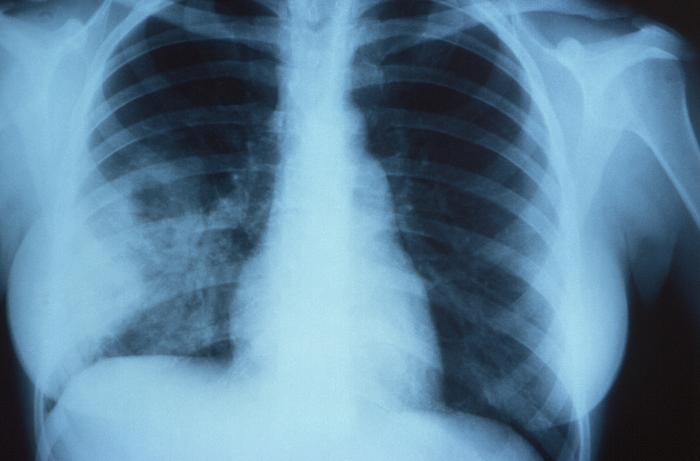Anteroposterior (AP) x-ray revealed the telltale signs of non-encapsulated pulmonary cryptococcosis. From Public Health Image Library (PHIL). [3]