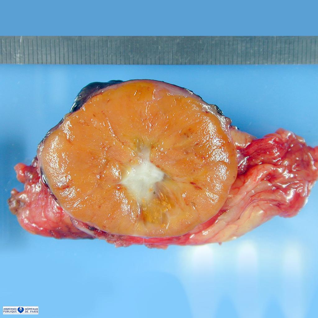 File:Gross pathology of renal oncocytoma.jpg