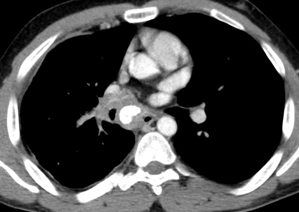 Axial CT demonstrating airway narrowing of the right lower lobe bronchus. There is thickening of the right pleura and right interlobular septae. There are partially calcified right hilar and mediastinal lymph nodes.[4]