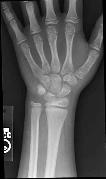 Salter-Harris fracture-I Image courtesy of RadsWiki and copylefted