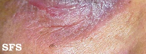 Discoid lupus erythematosus. Adapted from Dermatology Atlas.[9]