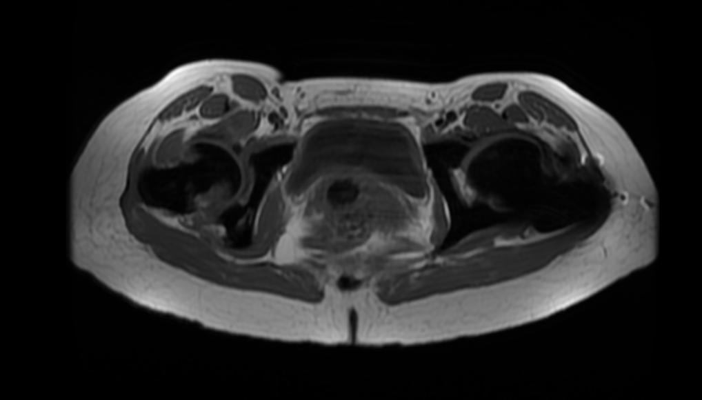 File:Osteopetrosis MRI 204.jpg