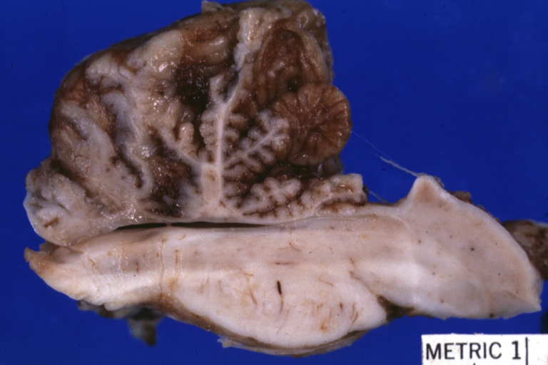 Brain: Arnold Chiari Malformation: Gross fixed tissue brain stem sagittal section close-up
