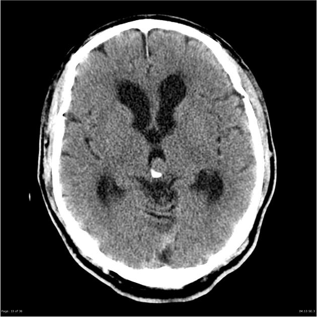 A 14 X 13 mm (axial) soft tissue density mass in the pineal region with eccentric peripheral calcification demonstrated. The ventricles are prominent, out of keeping with the degree of sulcal prominence, indicating mild to moderate obstructive hydrocephalus due to the lesion partially obstructing the upper margin of the cerebral aqueduct. Periventricular hypoattenuation is in keeping with chronic small vessel ischaemia +/- transependymal CSF accumulation.[22]