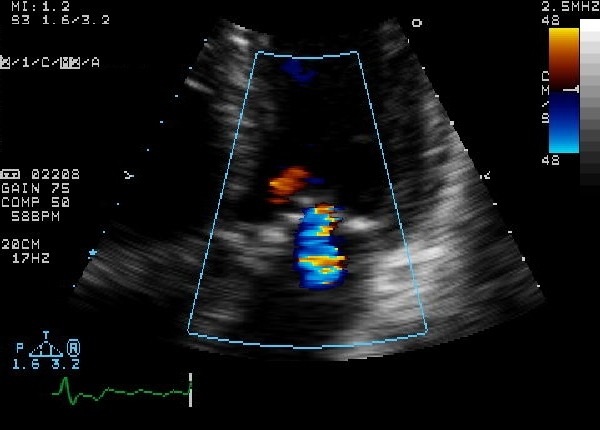 Diastolic mitral regurgitation due to severe aortic stenosis