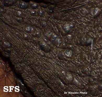 Fordyce,s spot. Adapted from Dermatology Atlas.<ref name="Dermatology Atlas">{{Cite