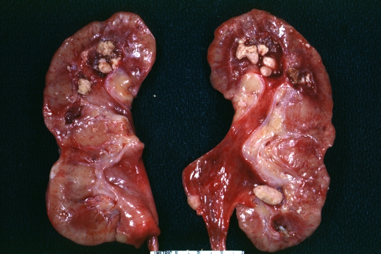 Kidney: Uric Acid Nephropathy: Gross, natural color, an excellent view of hydronephrosis with inflamed pelvis and multiple calculi with deposits in medullary pyramids