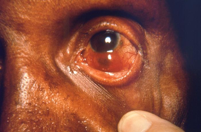Lepromatous leprosy revealing staphyloma of left eyeball (protrusion of the wall of the eyeball, exhibiting a dark coloration) potentially leading to degeneration of globe.Adapted from Public Health Image Library (PHIL), Centers for Disease Control and PreventionPublic Health Image Library (PHIL), Centers for Disease Control and Prevention[5]