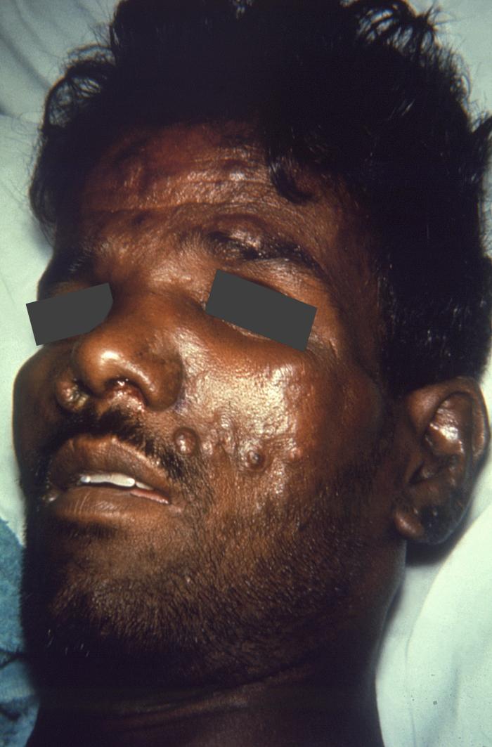 Complications of nodular lepromatous or multibacillary leprosy. Note cutaneous nodules on forehead and left cheek, as well as stricture of both nares, and nasal exudate.Adapted from Public Health Image Library (PHIL), Centers for Disease Control and PreventionPublic Health Image Library (PHIL), Centers for Disease Control and Prevention[5]