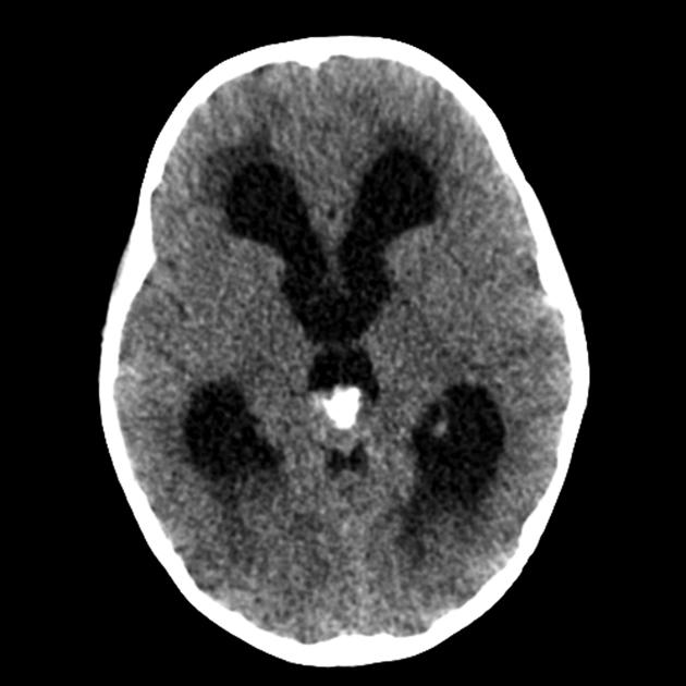 Single head CT image demonstrates a soft tissue mass in the region of the pineal gland with eccentric calcification (anterior) and evidence of hydrocephalus.[23]