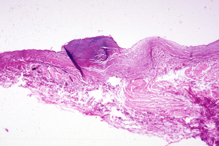 Pulmonary vein stenosis: Micro low mag, H&E, junction of pulmonary vein and atrium