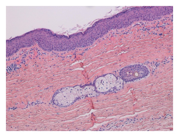 Pathology of a sublingual cyst showing orthokeratinized stratified squamous epithelium with a flat epithelial-connective tissue interface lining the cystic cavity, sebaceous glands, and hair, along with copious sebaceous material.[8]