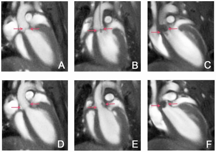 File:Vegetations on the aortic valve.jpg