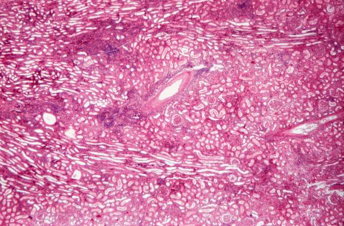 This is a higher-power photomicrograph demonstrating the cellular infiltrates within this kidney section. Note that in addition to the diffuse cellularity, the focal accumulations of cells appear to be focused around blood vessels.