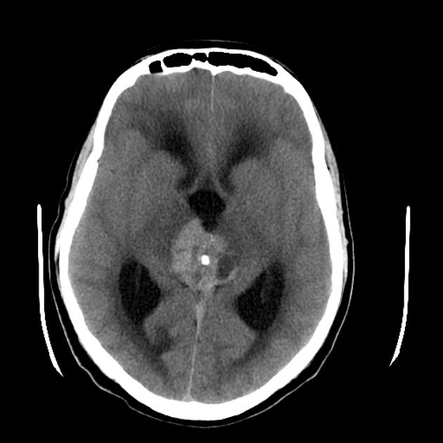 Axial non contrast CT of germinoma[2]