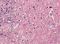 A smear showing angiomatous meningioma with hyalinized vessels