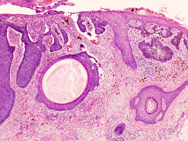 File:Basal cell carcinoma histopathology (2).jpg
