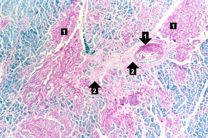 This is a special stain for amyloid (Luxol PAS) demonstrating the amyloid (1) and fibrosis (2) in the myocardium. The amyloid is darker purple/magenta and tends to be more amorphous. The fibrosis is pink and more fibrillar.