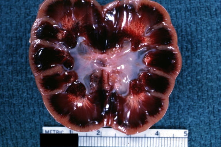 Kidney: Uric Acid Infarcts: Gross natural color opened kidney showing marked ischemia with dark red medullary pyramids which contrast sharply with the uric acid deposits