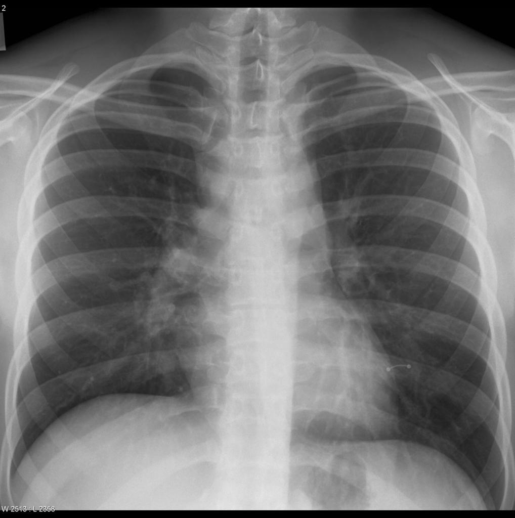 Chest x-ray demonstrates widening of the mediastinal outlines and widening of the right para tracheal stripe.[3]
