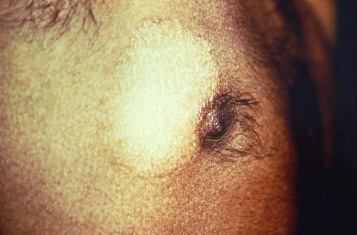 Tuberculoid or paucibacillary leprosy lesion with hypopigmented cutaneous plaque lateral to right nipple. Note elevated scaly borders.Adapted from Public Health Image Library (PHIL), Centers for Disease Control and PreventionPublic Health Image Library (PHIL), Centers for Disease Control and Prevention[5]