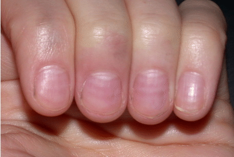 Muehrcke's nails: paired horizontal white bands separated by normal color Source:Wikimedia commons [17]