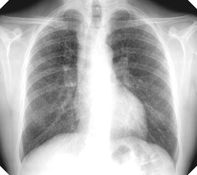 X Ray of the lung of a patient with silicosis