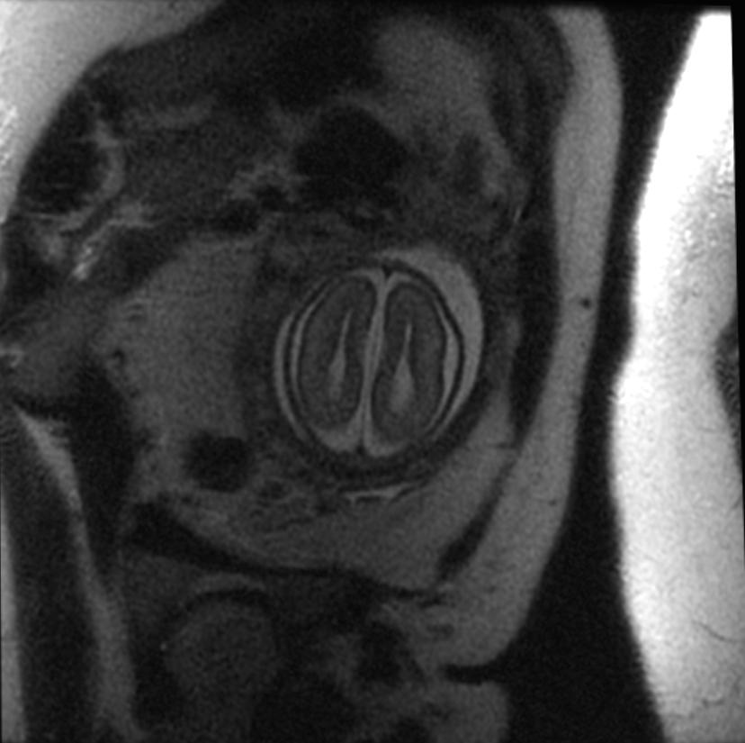 File:Agenesis of the corpus callosum fetal MRI 002.jpg