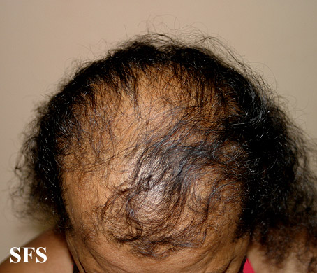 File:Alopecia androgenetica111.jpg