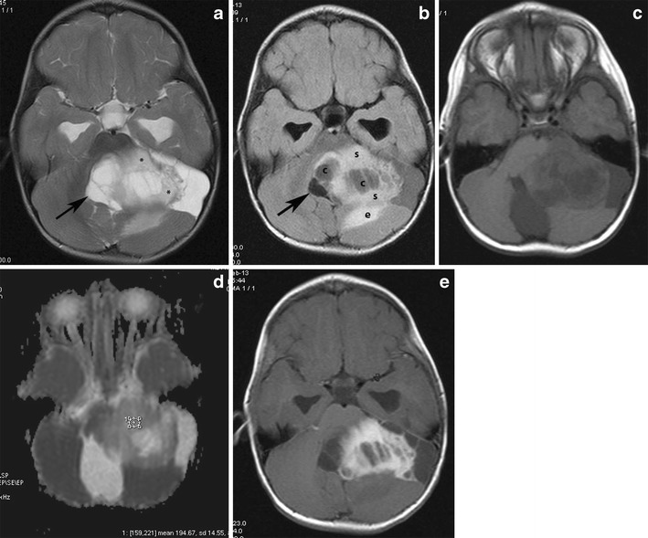 Pilocytic astrocytoma of the left cerebellar hemisphere with a solid and cystic component severely compressing the fourth ventricle and the medulla, producing obstructive hydrocephalus. a An axial T2-weighted image shows a cystic, hyperintense mass with a less intense solid component (asterisks) compressing the fourth ventricle (arrow). b On a FLAIR image, the cystic component (c) shows low signal intensity, which is higher than that of the CSF and the solid component (s) shows high signal intensity. Note the low signal of the compressed fourth ventricle (arrow) and the peritumoral edema (e). c On this T1-weighted image, the solid components appear hypointense compared with grey matter. d The solid component shows high values on an ADC map. e Intense enhancement of solid components is depicted after the administration of a paramagnetic agent.[2]