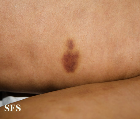 File:Painful bruising syndrome13.jpg