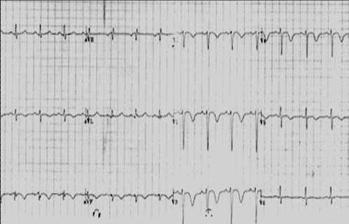 A common ECG finding in pulmonary embolism is anterior T wave inversion.