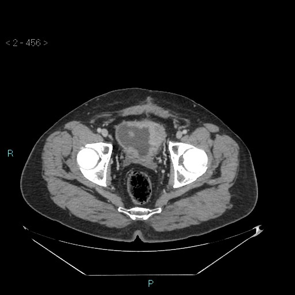 File:Urothelial-bladder-cancer.jpg