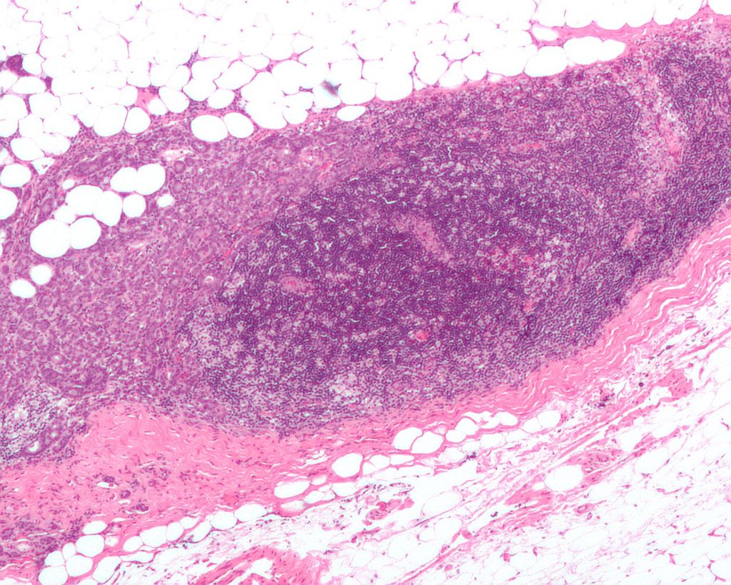File:Breast carcinoma in a lymph node biopsy.jpg