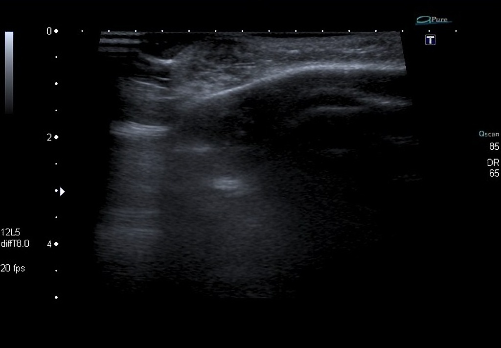 Color Doppler image demonstrates a 1.5 cm highly vascular mass consistent with a capillary hemangioma located at the superolateral margin of the right orbit.[1]