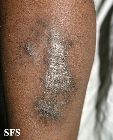 Lichen simplex. Adapted from Dermatology Atlas.[1]