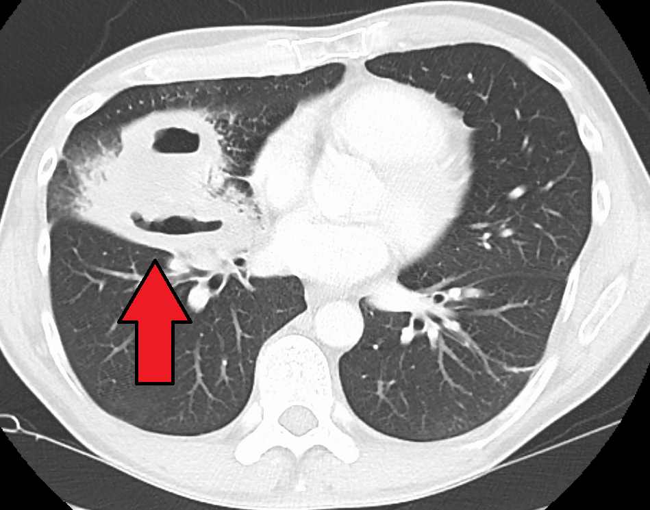 File:Lung abscess ct.png
