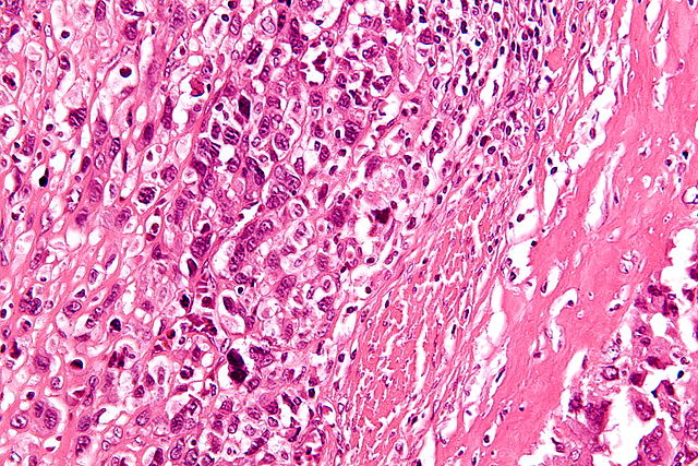 High-magnification micrograph showing osteoid formation in an osteosarcoma H&E stain https://en.wikipedia.org/wiki/Osteosarcoma
