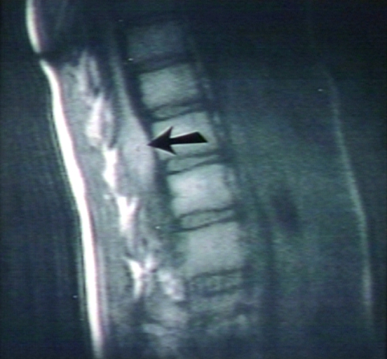 Spinal cord ependymoma