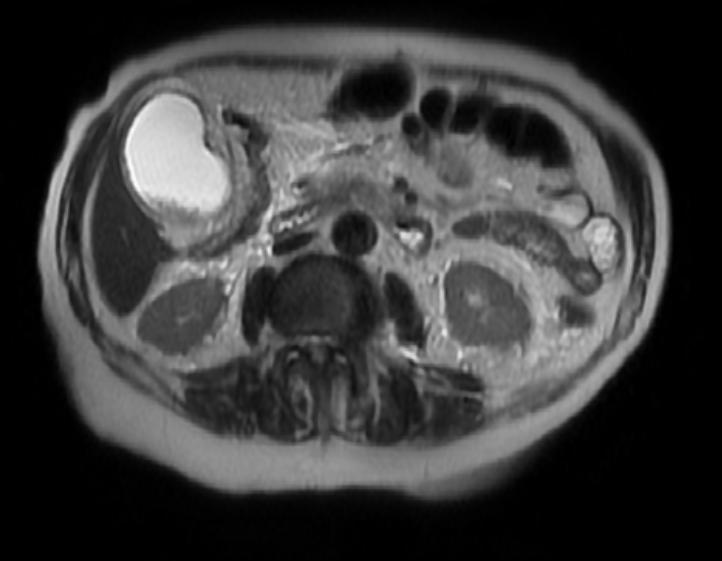 File:Acute cholecystitis MRI 001.jpg