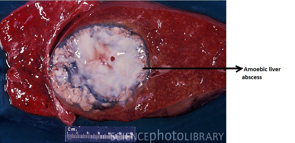 File:Amoebic-Liver-abscess-Gross-specimen-of-liver-tissue-with-an-abscess-white.jpg