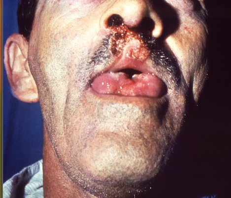 This male patient from the country of Brazil presented with a fungal infection of the face affecting his right eye, upper lip, nares, and tongue. The infection, known as paracoccidioidomycosis, which is also known as Lutz-Splendore-Almeida disease, or Brazilian blastomycosis, is caused by the fungal organism, Paracoccidioides brasiliensis. From Public Health Image Library (PHIL). [3]