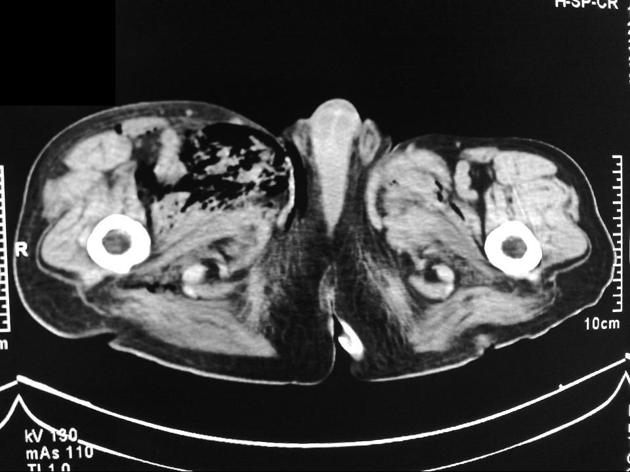 CT scan of hip showing subcutaneous emphysema - Case courtesy of Dr Wael Nemattalla, Radiopaedia.org, rID: 8674
